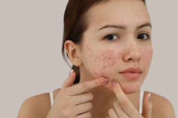 Battling Breakouts A Teen’s Journey to Conquering Acne