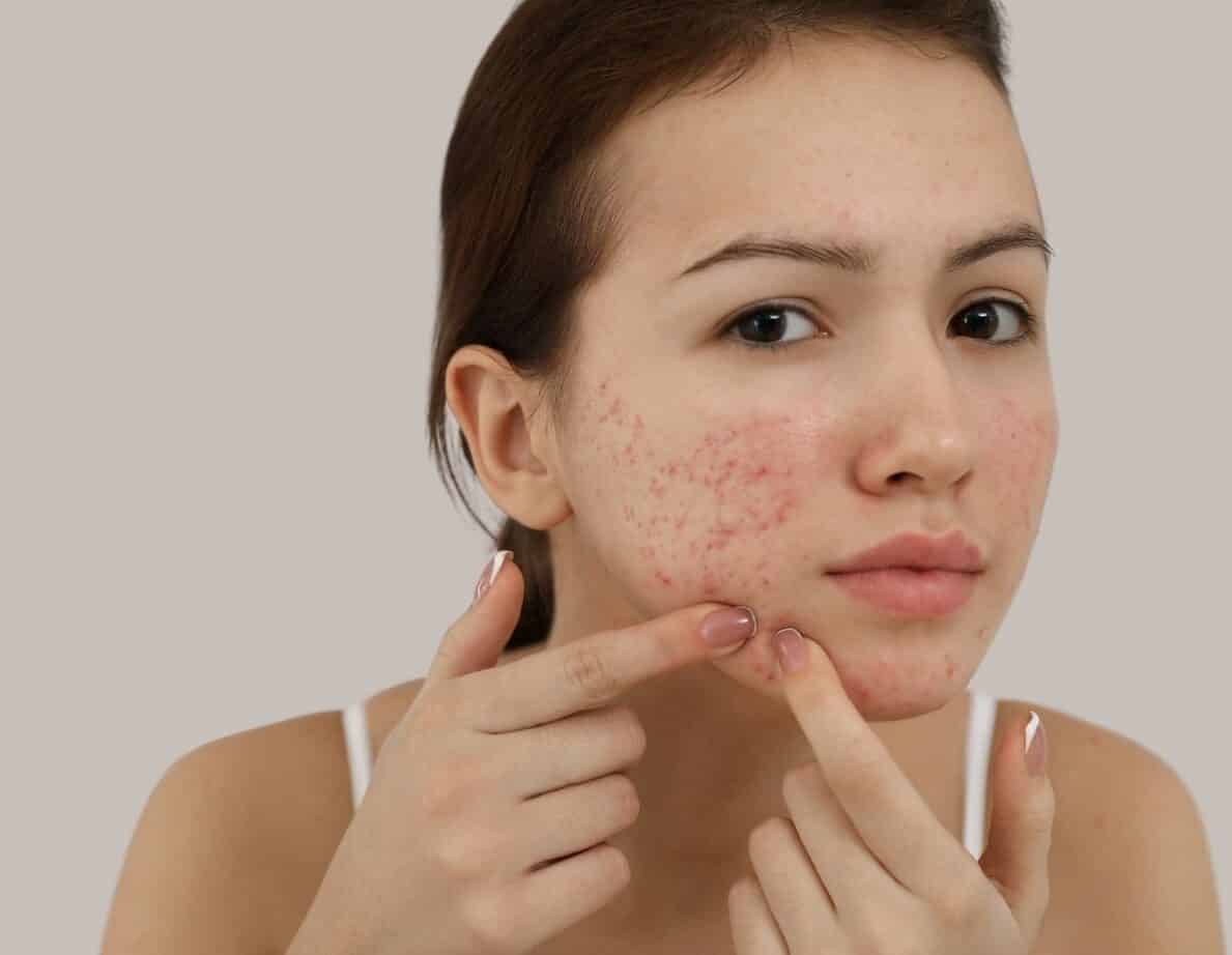 Battling Breakouts A Teen’s Journey to Conquering Acne