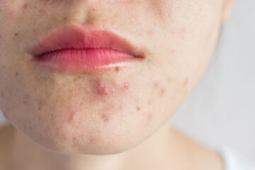 Discover the Best Skincare for Rosacea and Perioral Dermatitis